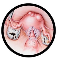 Endometrióza - Endometrium